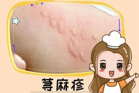 荨麻疹2.jpg 荨麻疹2.jpg