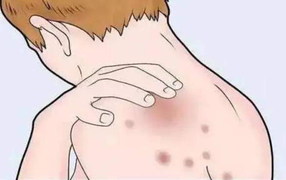 皮肤湿疹3.jpg 皮肤湿疹3.jpg